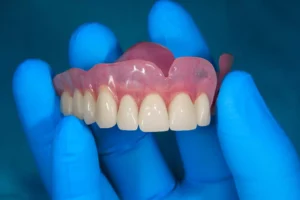 Comment se fixe une prothèse dentaire amovible ?