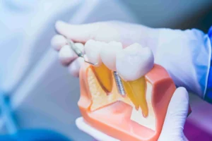 Est-il possible de se refaire les dents sans implants ?