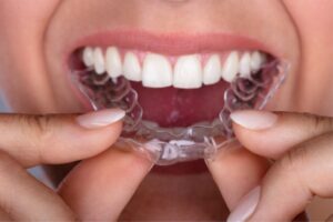 Qu'est-ce que le traitement orthodontique par aligneurs invisibles ?