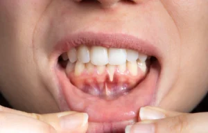 Est-ce qu'un implant dentaire peut causer un déchaussement des dents ?