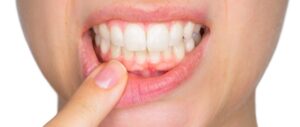 Combien de temps faut-il pour qu'une gencive se referme ?