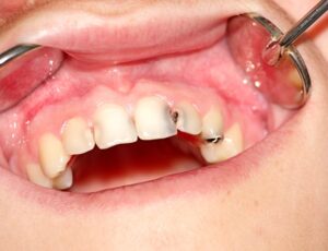 Est-il possible de faire disparaître une carie dentaire sans aller chez le dentiste ?