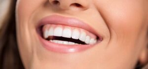 Est-il possible de poser des facettes sans limer les dents ?