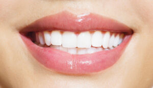 Puis-je faire blanchir mes dents si j’ai des couronnes ?