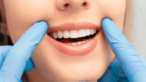 Cap dentaire en céramique