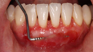 Chirurgie parodontale en Tunisie