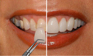 Composite vs facettes