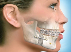 Reconstruction osseuse faciale en Tunisie