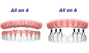 Technique All-on-4 et All-on-6