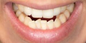 Comment corriger une malocclusion sévère