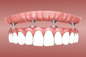 Réhabilitation complète sur implants en Tunisie