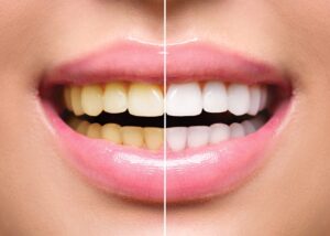 Pourquoi mes dents restent-elles jaunes malgré un brossage régulier ?