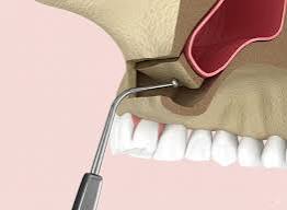Sinus lift