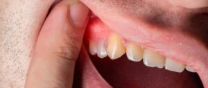 Chirurgie des kystes dentaires