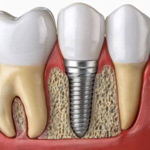 Sinus lift avant implants dentaires