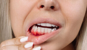 Récession gingivale