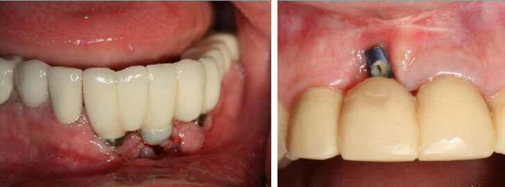 Pose implant dentaire avant après